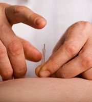 Acupuncture
